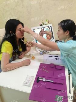 切开双眼皮消肿过程图_切开双眼皮恢复过程图