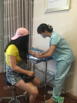 切开双眼皮消肿过程图_切开双眼皮恢复过程图