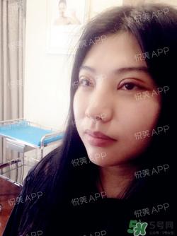 切开双眼皮消肿过程图_切开双眼皮恢复过程图