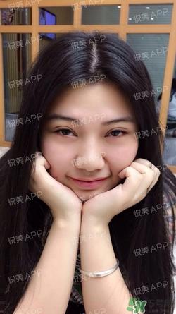 切开双眼皮消肿过程图_切开双眼皮恢复过程图