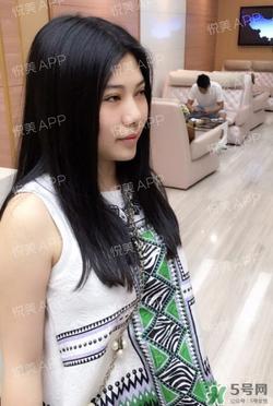 切开双眼皮消肿过程图_切开双眼皮恢复过程图