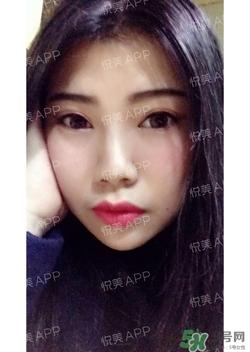 切开双眼皮消肿过程图_切开双眼皮恢复过程图