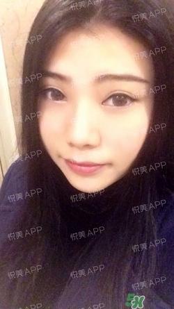 切开双眼皮消肿过程图_切开双眼皮恢复过程图
