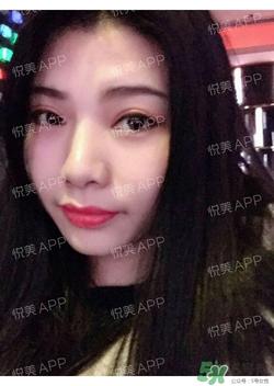 切开双眼皮消肿过程图_切开双眼皮恢复过程图