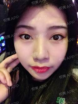 切开双眼皮消肿过程图_切开双眼皮恢复过程图