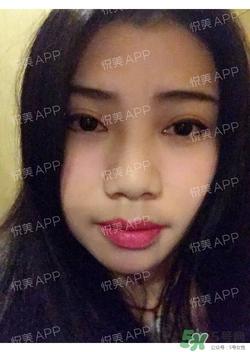 切开双眼皮消肿过程图_切开双眼皮恢复过程图