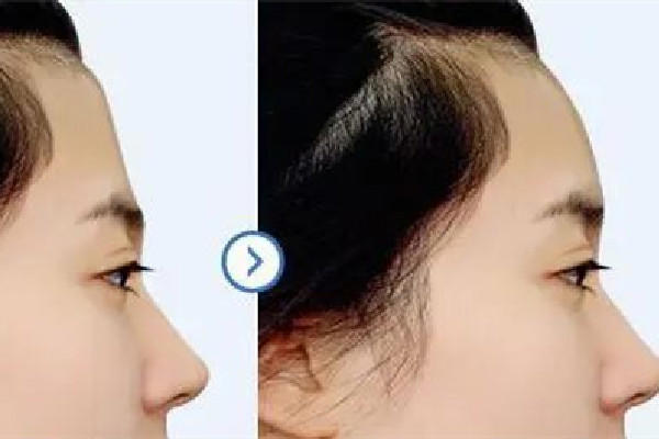 额头填充一般要多少钱 额头填充去什么医院