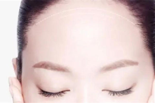 额头填充一般要多少钱 额头填充去什么医院