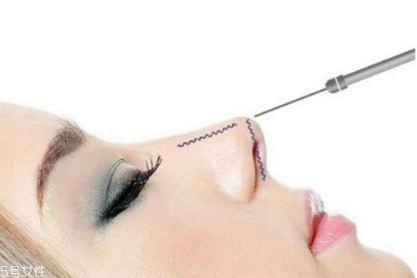 硅胶隆鼻取出多久消肿 鼻子硅胶取出亲身经历