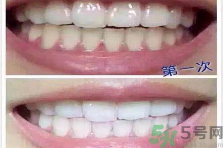 冷光美白牙齿的价格是多少？做冷光美白牙齿需要多少钱？