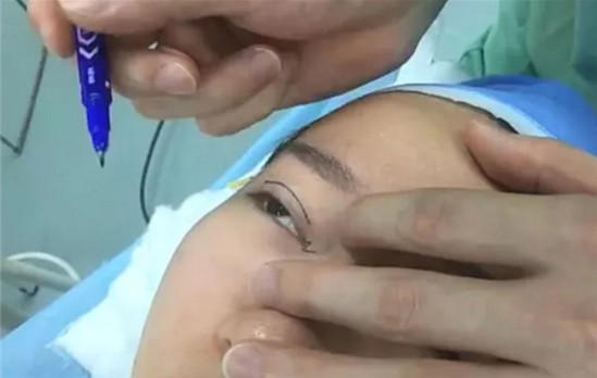 开内眼角要多久恢复 依个人体质而定