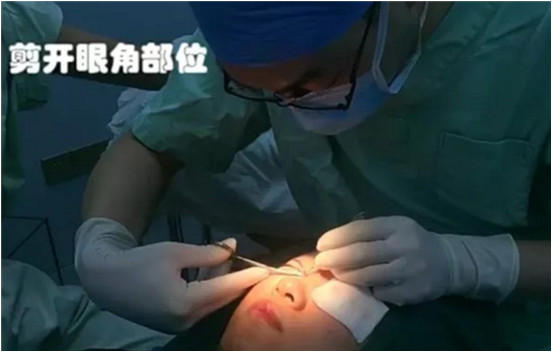 开内眼角要多久恢复 依个人体质而定