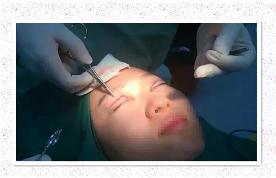 开内眼角要多久恢复 依个人体质而定