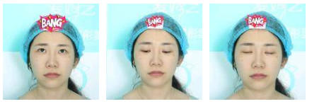 开内眼角要多久恢复 依个人体质而定