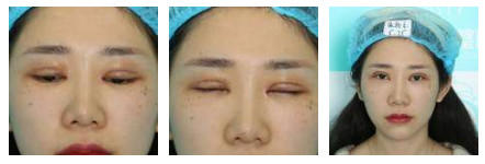 开内眼角要多久恢复 依个人体质而定