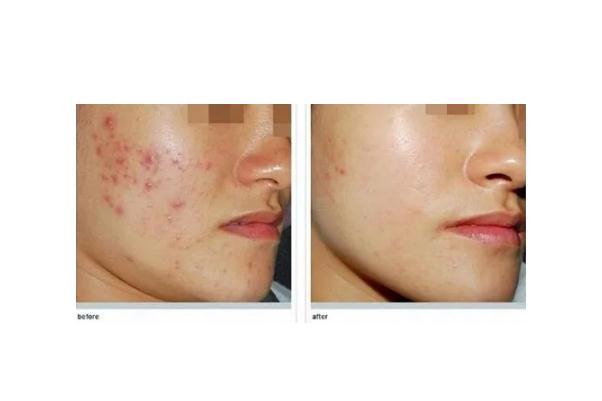 激光祛痘会留疤吗 激光祛痘会再次复发吗