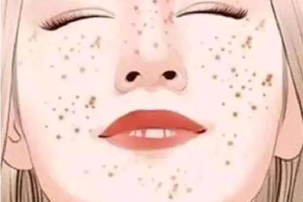 武汉激光祛斑哪个医院比较好 武汉激光祛斑多少钱一次