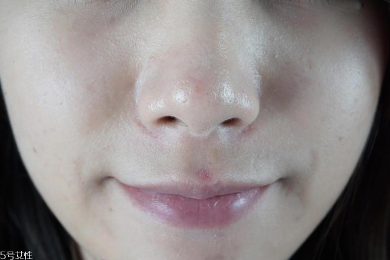 泊舒清痘霜有用吗 泊舒清痘能力实测