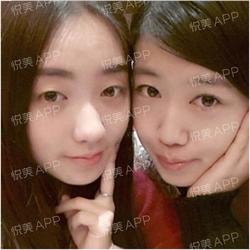 三点双眼皮恢复过程图_韩式三点双眼皮多久恢复自然