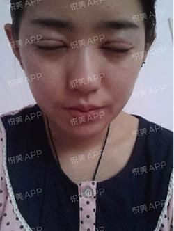 三点双眼皮恢复过程图_韩式三点双眼皮多久恢复自然