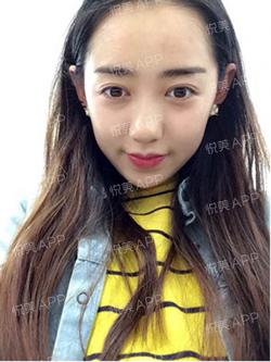 三点双眼皮恢复过程图_韩式三点双眼皮多久恢复自然