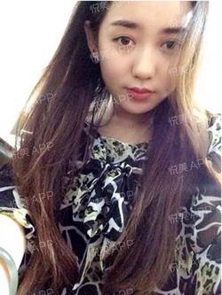 三点双眼皮恢复过程图_韩式三点双眼皮多久恢复自然