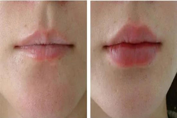 丰唇大概要多少钱 丰唇有哪些方法