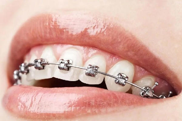 武汉矫正牙齿哪家医院好 武汉矫正牙齿多少钱