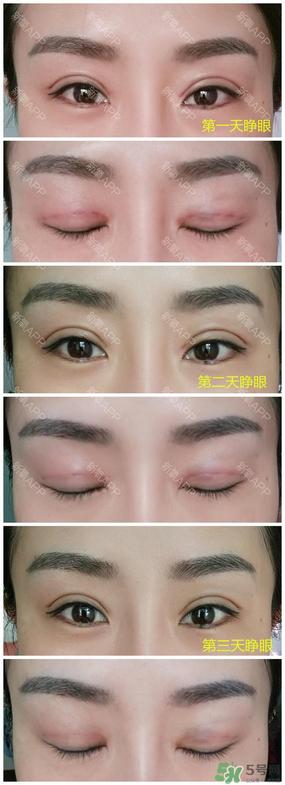埋线双眼皮能保持多久？埋线双眼皮是永久吗