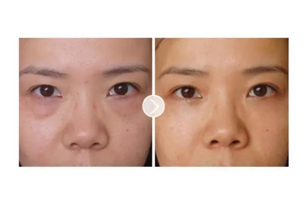 去眼袋手术会失败吗 去眼袋手术会导致眼失明吗