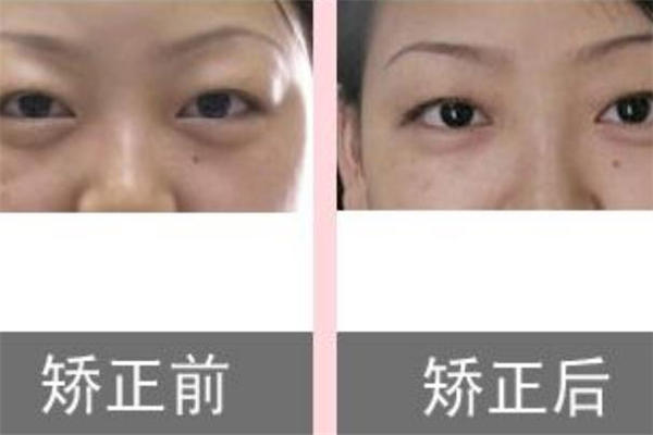 眼皮抽脂效果好吗 眼皮抽脂前后效果对比