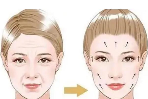 拉皮手术是拉的筋膜层还是皮肤层 拉皮手术是大手术吗