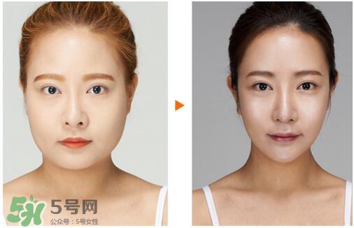 瘦脸针分为几种类型？瘦脸针有哪几个牌子？