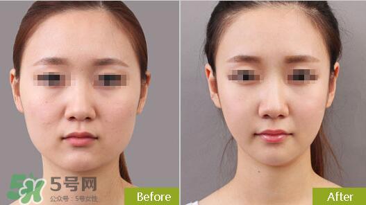 瘦脸针分为几种类型？瘦脸针有哪几个牌子？