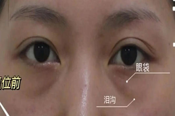 填泪沟用什么方法最好 填泪沟有几种方法