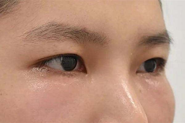 填泪沟用什么方法最好 填泪沟有几种方法