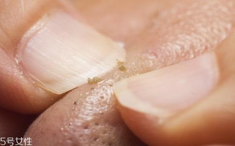 去黑头用什么最有效？徒手挤黑头容易感染