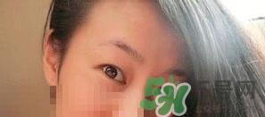 定点双眼皮恢复过程图_定点双眼皮要多久恢复