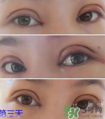 定点双眼皮恢复过程图_定点双眼皮要多久恢复