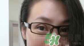 定点双眼皮恢复过程图_定点双眼皮要多久恢复