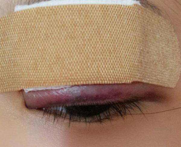 定点双眼皮恢复过程图_定点双眼皮要多久恢复