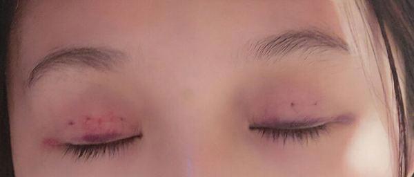 定点双眼皮恢复过程图_定点双眼皮要多久恢复