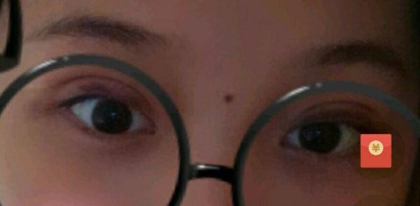 定点双眼皮恢复过程图_定点双眼皮要多久恢复