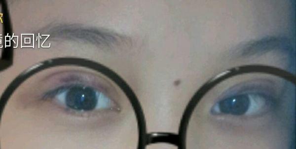 定点双眼皮恢复过程图_定点双眼皮要多久恢复