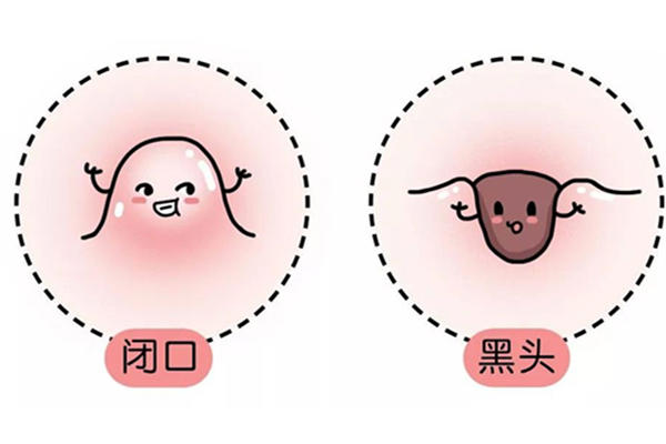 闭口长啥样 闭口怎么除