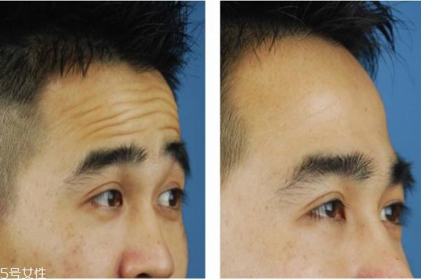 抬头纹怎么去除？小妙招教给你