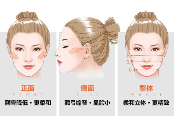 颧骨内推手术多少钱啊 颧骨内推后遗症