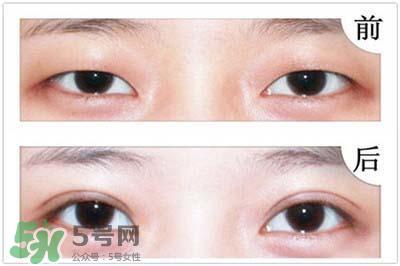 欧式双眼皮适合什么人 欧式双眼皮前后对比