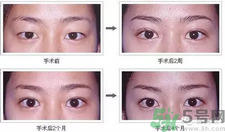 提眉术后多久可以恢复？提眉术后全过程照片