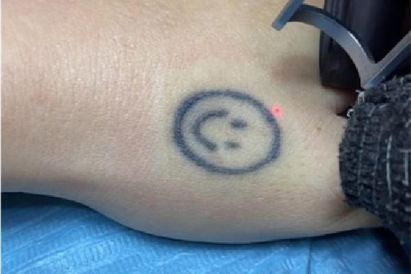 洗纹身一般要洗几次才能干净 洗纹身可以完全洗掉吗